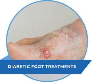 diabetic-foot-treatments