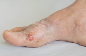 diabetes-foot-treatment